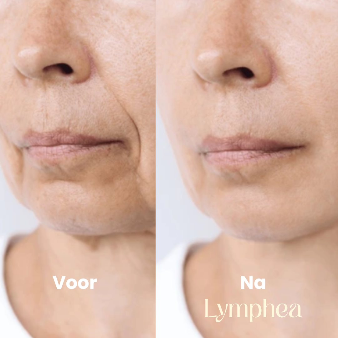 Lymphea Brostel