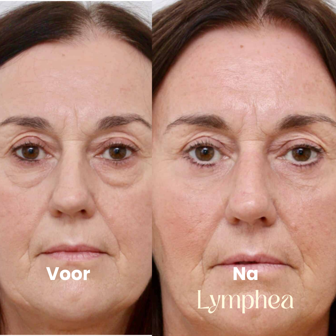 Lymphea Brostel