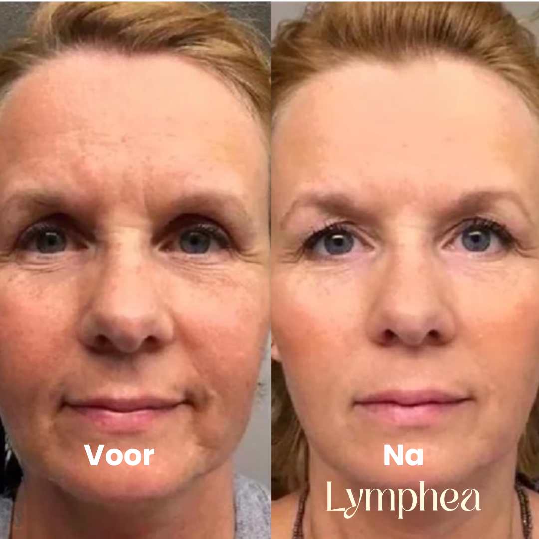 Lymphea Brostel